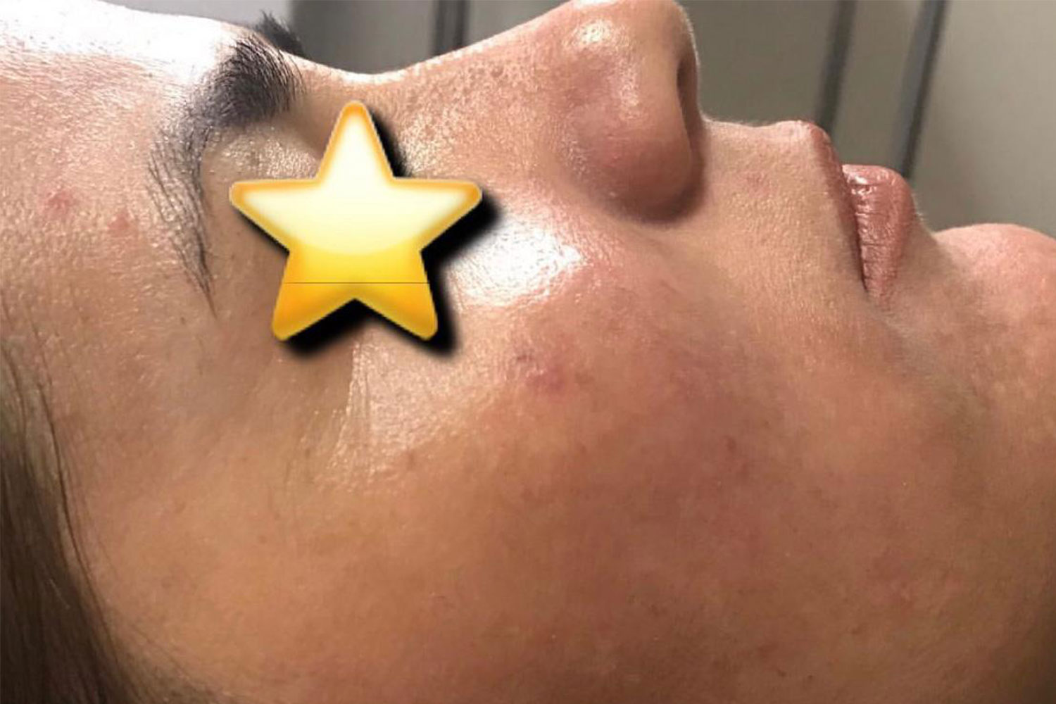 Microneedling-Borås