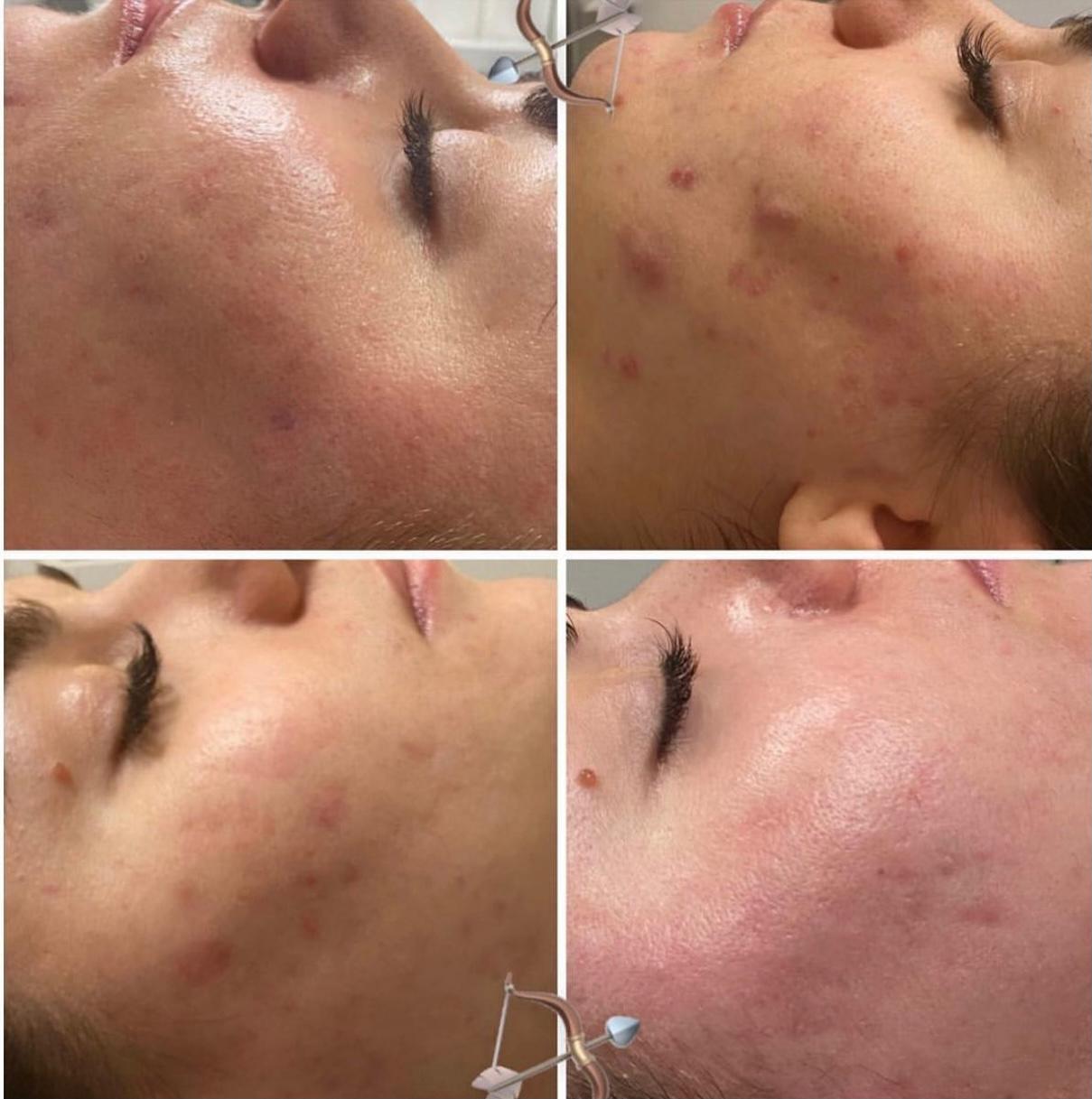 Microneedling Borås